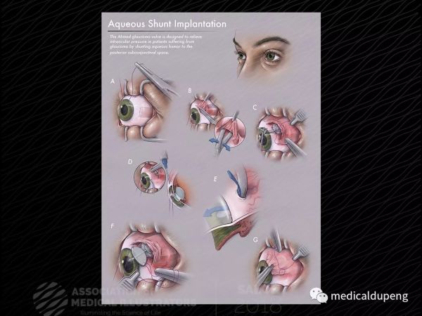 房水分流器植入术 Aqueous Shunt Implantation 北美医学插画师协会 2018 沙龙展